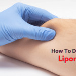 Lipoma treatment with homeopathic medicines