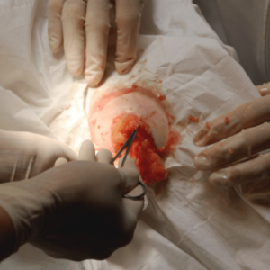 lipoma treatment with surgery